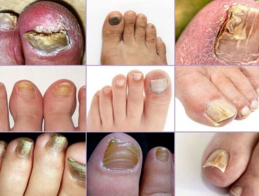 Nagelschädigung an verschiedenen Arten von Pilzen