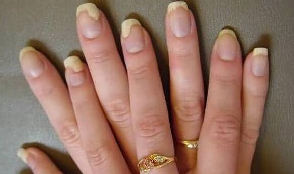 So sieht der Nagelpilz in der Exazerbationsphase aus