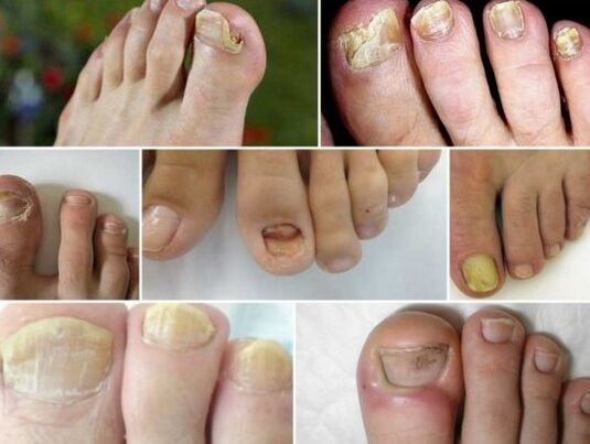 Verschiedene Formen von Nagelpilzen
