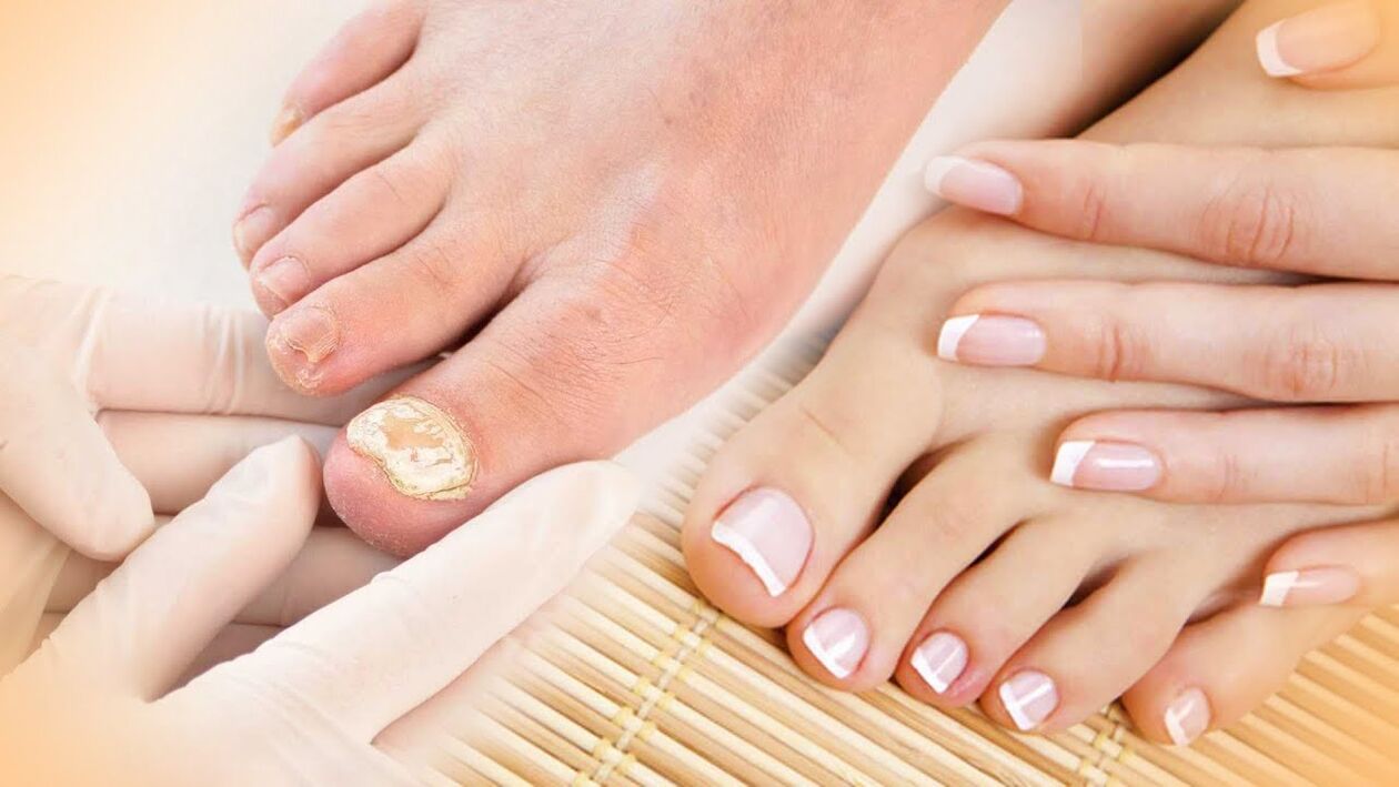 Nagelpilz