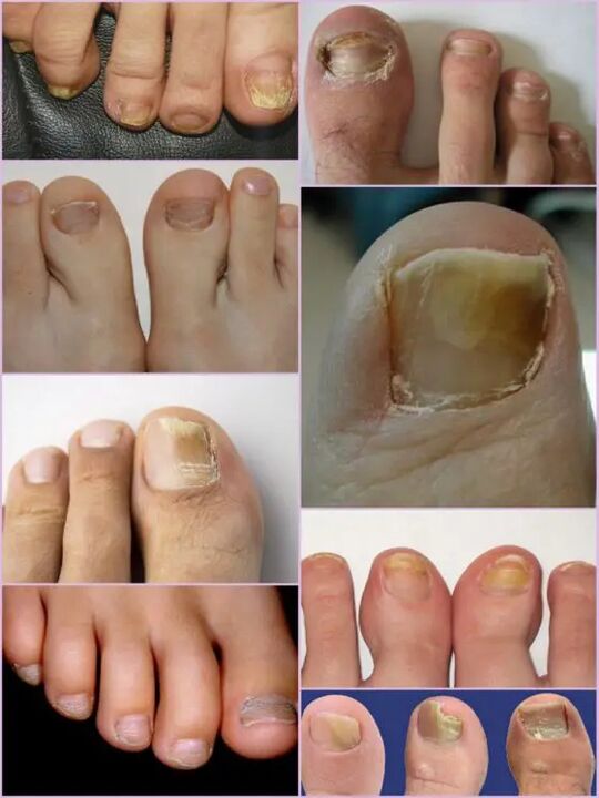 Sorten von Nagelpilz