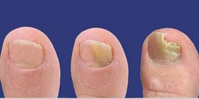 Entwicklungsphasen von Nagelpilz